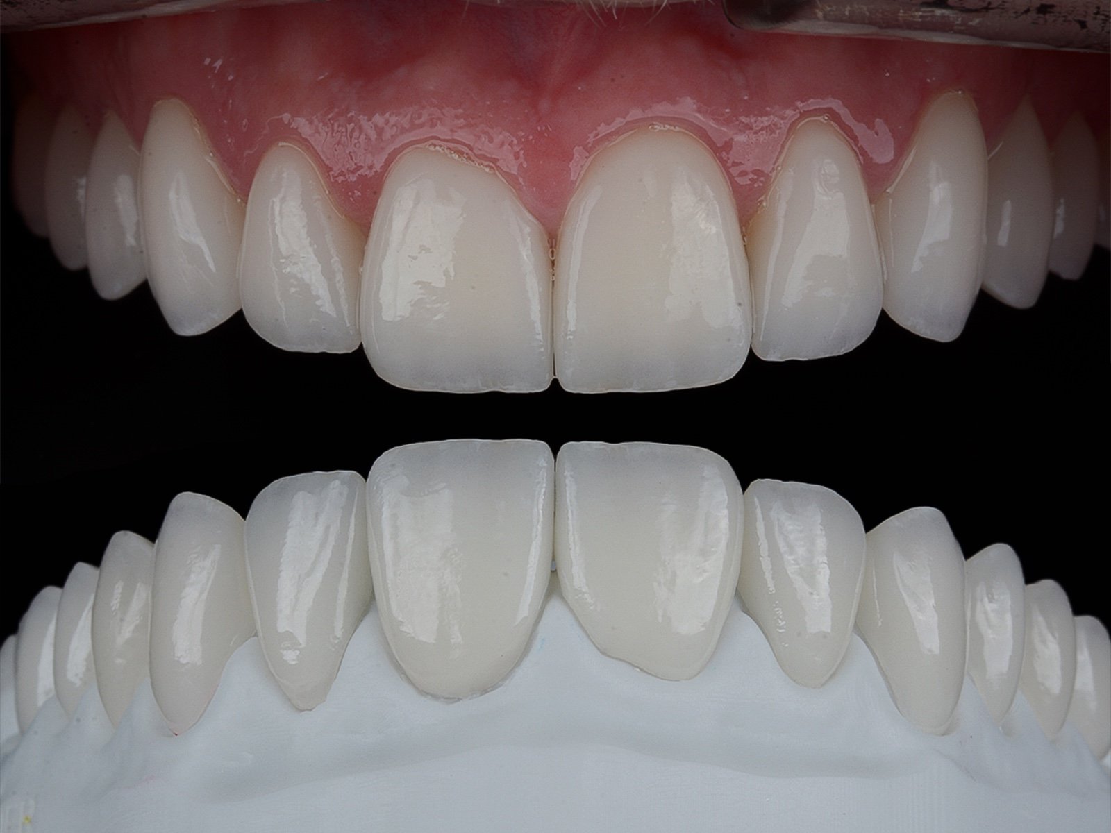 Caso clínico com detalhes de forma e proporção dos dentes