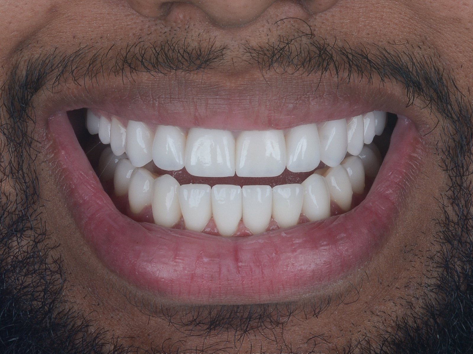 Sorriso frontal com lentes planejadas individualmente